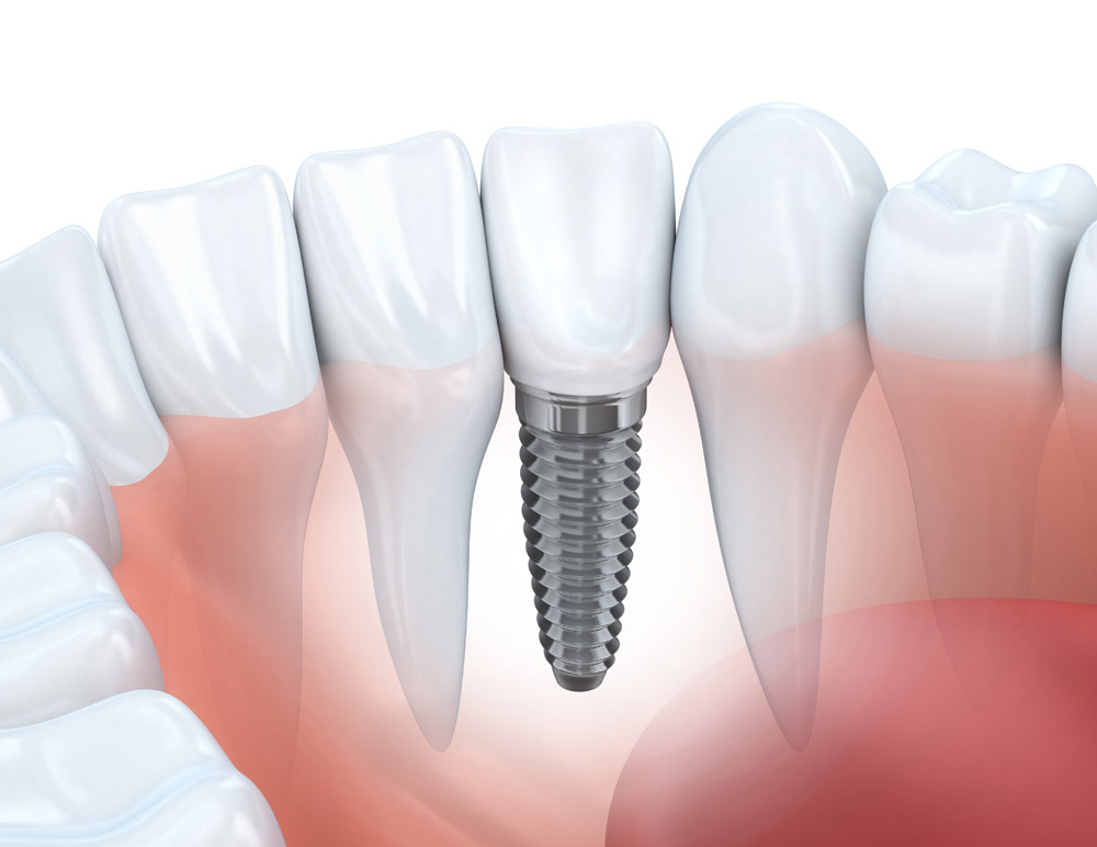 Illustrazione di un impianto dentale